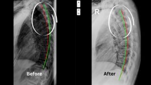 Spinal X-ray comparison showing hyperkyphosis before and after chiropractic posture correction with improved alignment