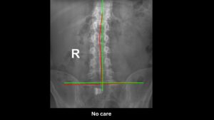 X-ray of a young athlete with no pain and no prior chiropractic care showing visible spinal and pelvic imbalance at 100+Living Health Centres in Kelowna.
