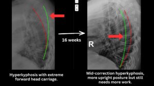 Before and after X-rays showing improvement in thoracic hyperkyphosis and forward head posture following 16 weeks of corrective chiropractic rehabilitation at 100+Living Health Centres.