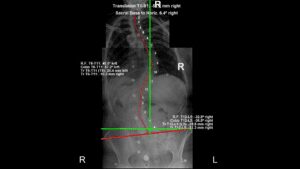 Standing X-ray of adult scoliosis in a patient over 50 showing Cobb angle measurements and spinal curve analysis at 100+Living Health Centres in Kelowna.