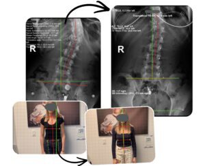 Before and after image showing Sarah’s scoliosis posture and X-ray changes following conservative scoliosis rehabilitation at 100+Living Health Centres.