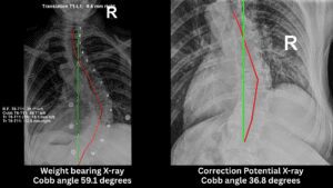 Weight-bearing scoliosis X-ray showing a 59.1 degree Cobb angle compared with correction potential X-ray in traction showing reduction to 36.8 degrees at 100+Living Health Centres in Kelowna.