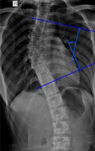 Standing scoliosis X-ray with Cobb angle markings showing spinal curvature measured accurately at 100+Living Health Centres in Kelowna.