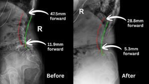 Before and after spinal X-ray showing improved posture and reduced forward translation following corrective chiropractic care