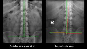 Side-by-side X-rays comparing regular chiropractic care and pain-based care in young athletes at 100+Living Health Centres in Kelowna.