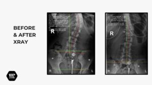 Before and after scoliosis X-rays showing significant reduction in spinal curvature and rib cage translation following corrective chiropractic rehabilitation at 100+Living Health Centers.